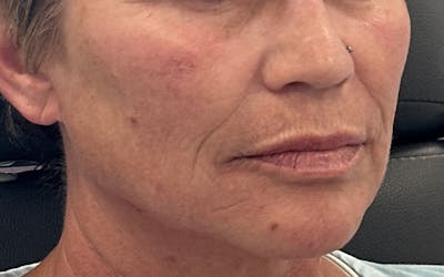 Lip Filler Before & After Gallery - Patient 162026 - Image 2