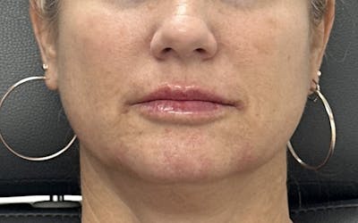 Lip Filler Before & After Gallery - Patient 366343 - Image 2