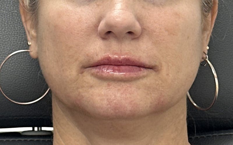 Chin Filler Before & After Gallery - Patient 229485 - Image 2