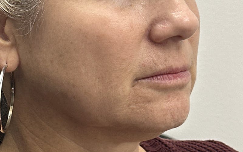 Chin Filler Before & After Gallery - Patient 229485 - Image 3