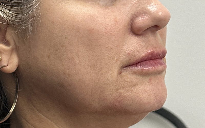 Chin Filler Before & After Gallery - Patient 229485 - Image 4
