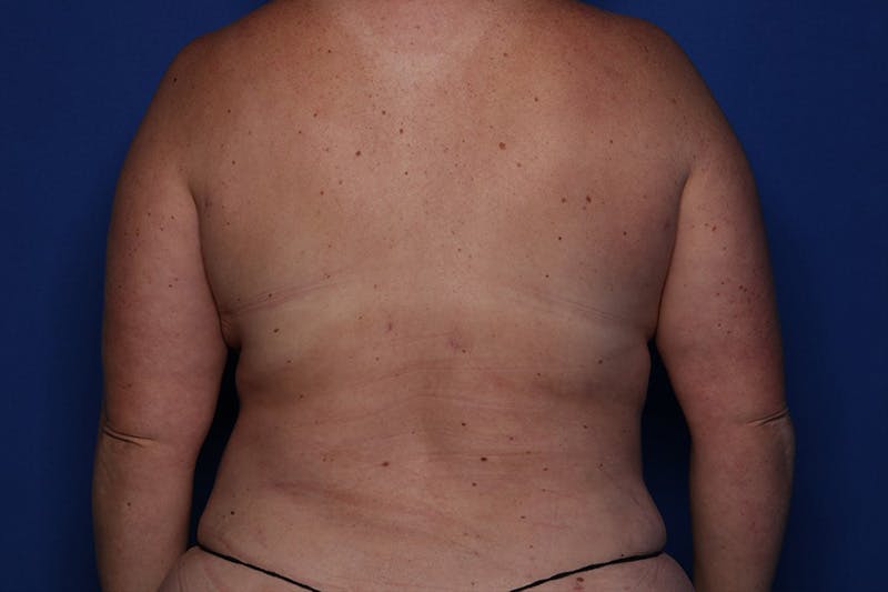 Tummy Tuck Before & After Gallery - Patient 243705 - Image 6