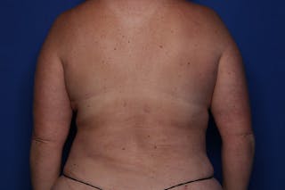 Tummy Tuck Before & After Gallery - Patient 243705 - Image 6