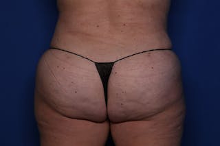 Tummy Tuck Before & After Gallery - Patient 243705 - Image 8