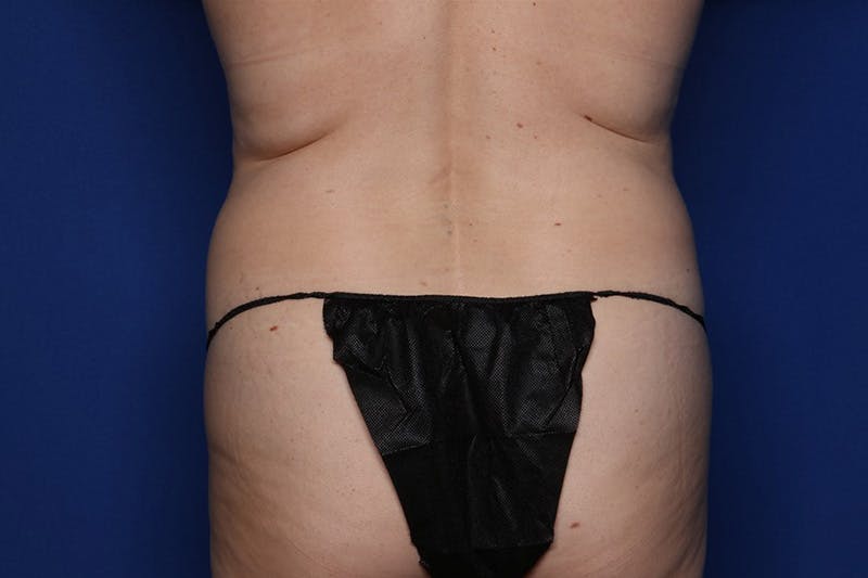 Tummy Tuck Before & After Gallery - Patient 268300 - Image 5
