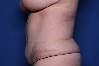 Tummy Tuck Before & After Gallery - Patient 170992 - Image 6