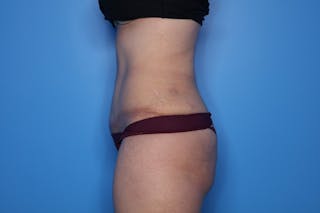 Tummy Tuck Before & After Gallery - Patient 290566 - Image 4
