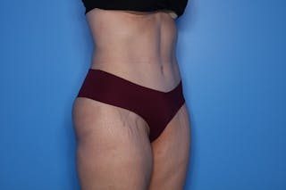 Tummy Tuck Before & After Gallery - Patient 290566 - Image 6