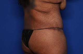 Body Lift Before & After Gallery - Patient 146807 - Image 6