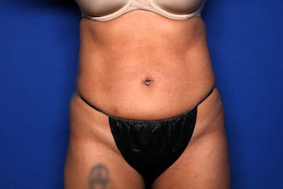 BodyTite™ Before and After Before & After Gallery - Patient 191387 - Image 2