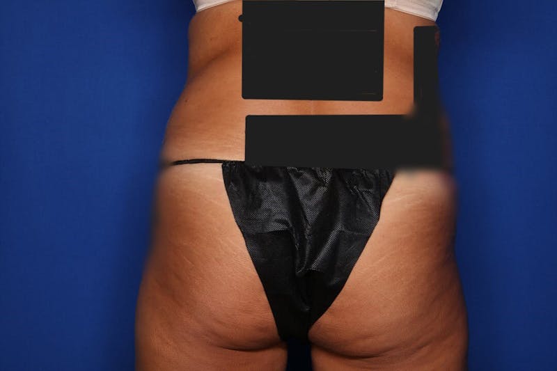BodyTite™ Before and After Before & After Gallery - Patient 191387 - Image 5