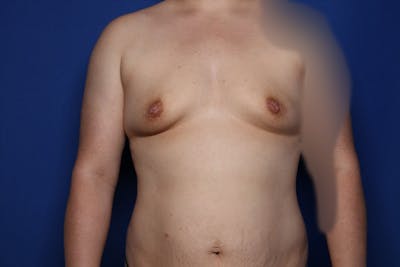 Breast Augmentation Before & After Gallery - Patient 412972 - Image 1