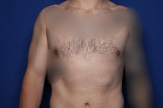Gynecomastia (Male Breast Reduction) Before & After Gallery - Patient 860284 - Image 2