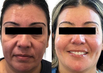 Clear + Brilliant® Before & After Gallery - Patient 289447 - Image 1