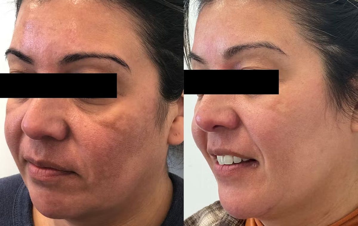 Juvéderm® Before & After Gallery - Patient 307116 - Image 2