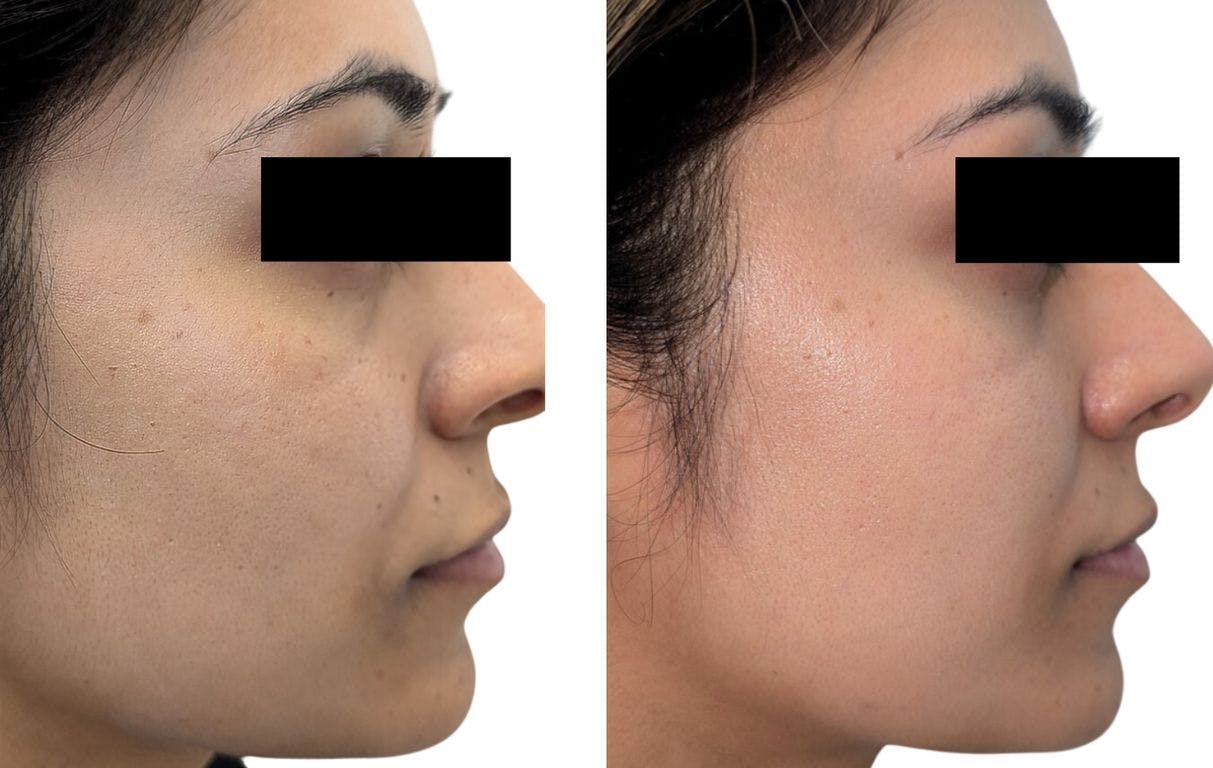 Microneedling with PRP Before & After Gallery - Patient 177718 - Image 1