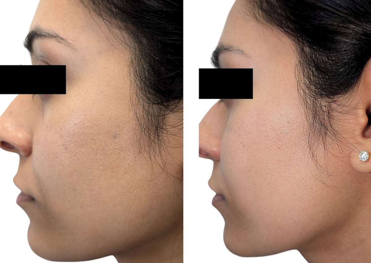 Microneedling with PRP Before & After Gallery - Patient 177718 - Image 2