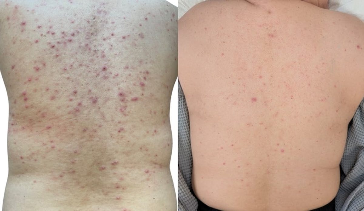 Sciton® BBL Hero Before & After Gallery - Patient 106841 - Image 1