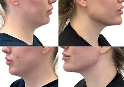 Jawline Filler Before & After Gallery - Patient 360626 - Image 1