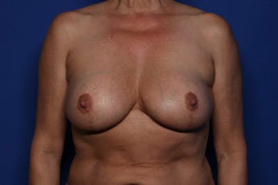 Implant Exchange Before & After Gallery - Patient 375909 - Image 1
