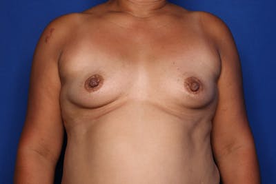 Breast Augmentation Before & After Gallery - Patient 174533 - Image 1