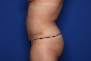 Tummy Tuck Before & After Gallery - Patient 623152 - Image 4