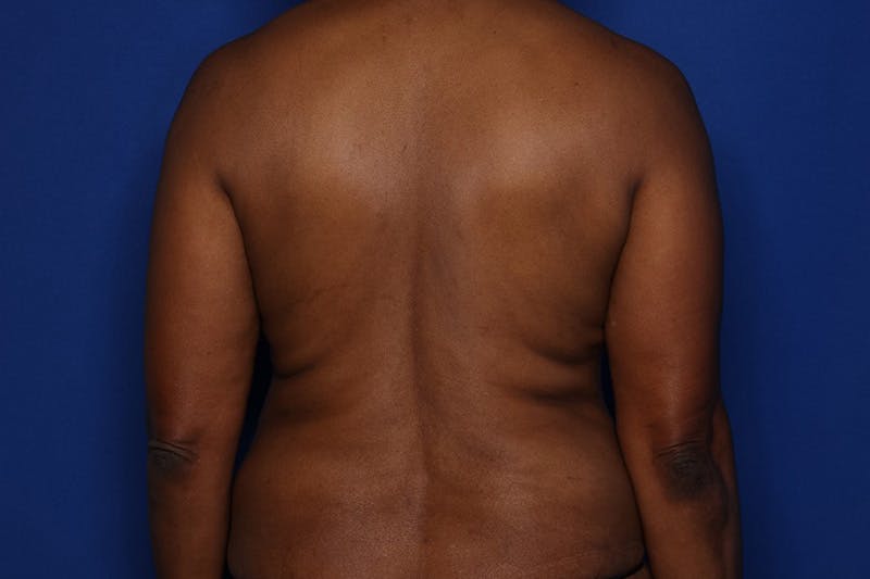 Tummy Tuck Before & After Gallery - Patient 897126 - Image 7