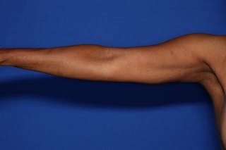 BodyTite™ Before and After Before & After Gallery - Patient 225233 - Image 6