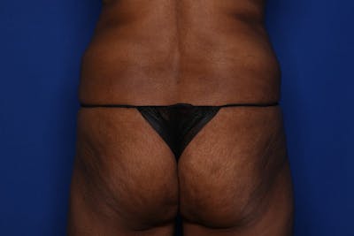 Brazilian Butt Lift Before & After Gallery - Patient 416286 - Image 1