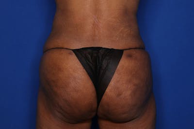 Brazilian Butt Lift Before & After Gallery - Patient 416286 - Image 2