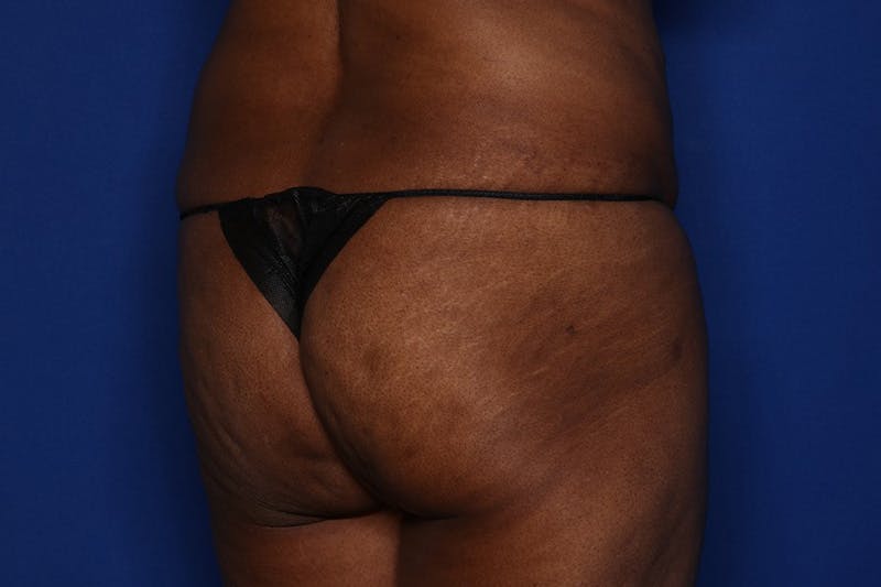 Brazilian Butt Lift Before & After Gallery - Patient 416286 - Image 3