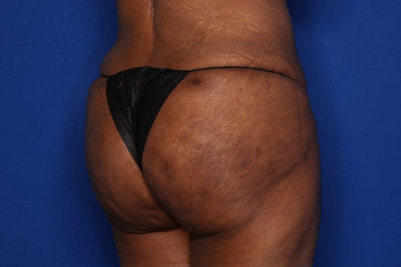 Brazilian Butt Lift Before & After Gallery - Patient 416286 - Image 4