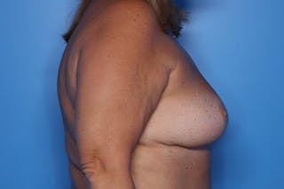 Breast Reduction Before & After Gallery - Patient 975190 - Image 6