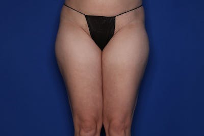 Liposuction Before & After Gallery - Patient 274654 - Image 1