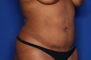 Liposuction Before & After Gallery - Patient 873926 - Image 4