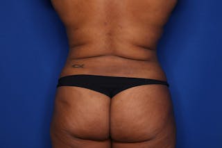 Liposuction Before & After Gallery - Patient 873926 - Image 6