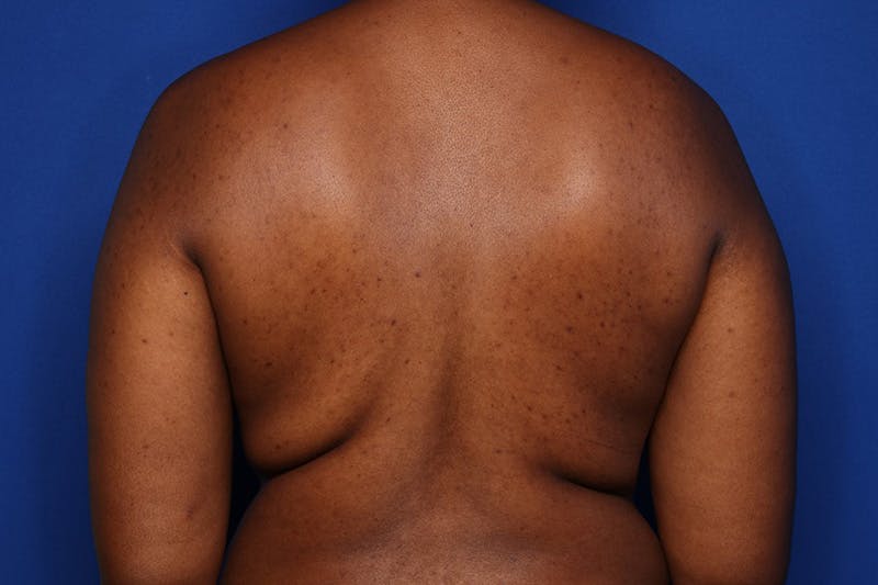 Tummy Tuck Before & After Gallery - Patient 413101 - Image 3