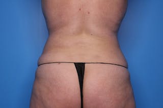 Liposuction Before & After Gallery - Patient 332847 - Image 4
