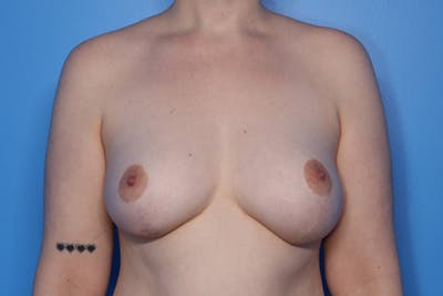 Breast Augmentation + Lift Before & After Gallery - Patient 228131 - Image 2