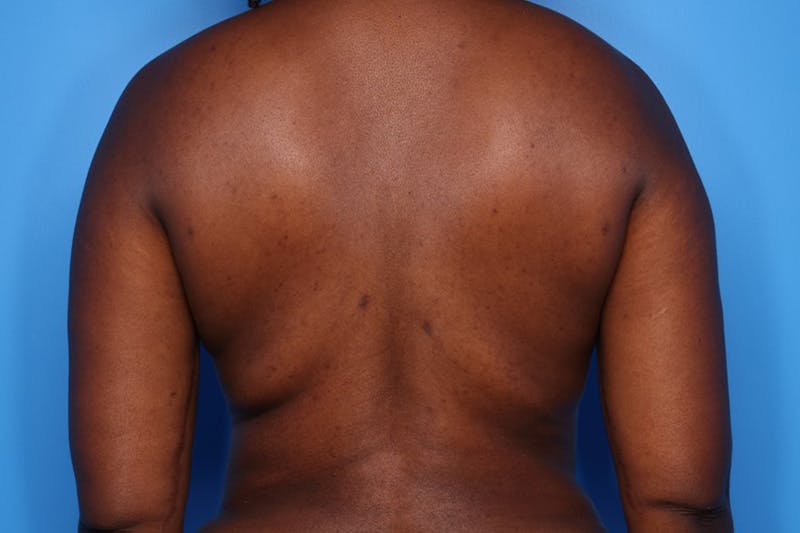 Tummy Tuck Before & After Gallery - Patient 413101 - Image 4