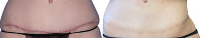 SkinPen® Microneedling Before & After Gallery - Patient 282527 - Image 1