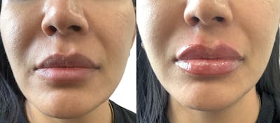 Lip Filler Before & After Gallery - Patient 407582 - Image 1
