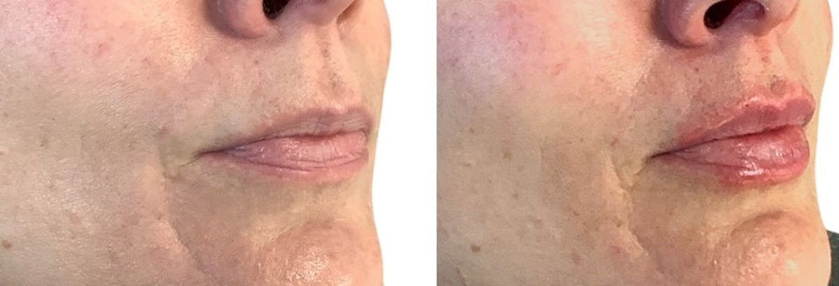 Lip Filler Before & After Gallery - Patient 100978 - Image 2