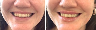 Juvéderm® Before & After Gallery - Patient 281473 - Image 1