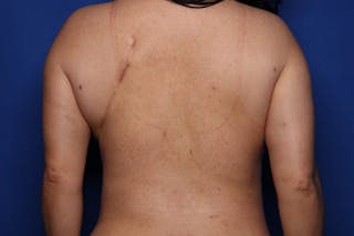 Mommy Makeover Before & After Gallery - Patient 371107 - Image 6