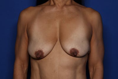 Breast Augmentation + Lift Before & After Gallery - Patient 187940 - Image 1