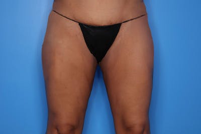 Body Lift Before & After Gallery - Patient 324915 - Image 2