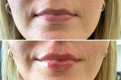 Lip Filler Before & After Gallery - Patient 273579 - Image 1