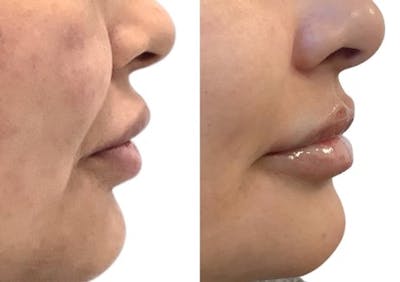 Lip Filler Before & After Gallery - Patient 319500 - Image 1