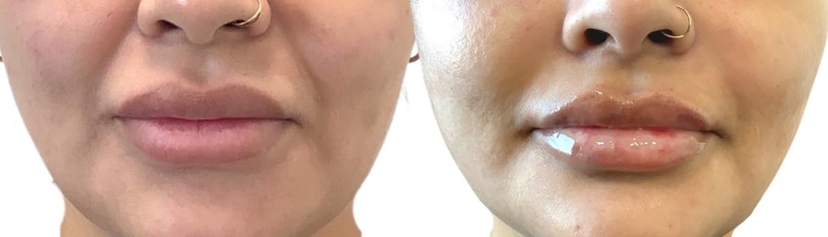 Lip Filler Before & After Gallery - Patient 319500 - Image 2